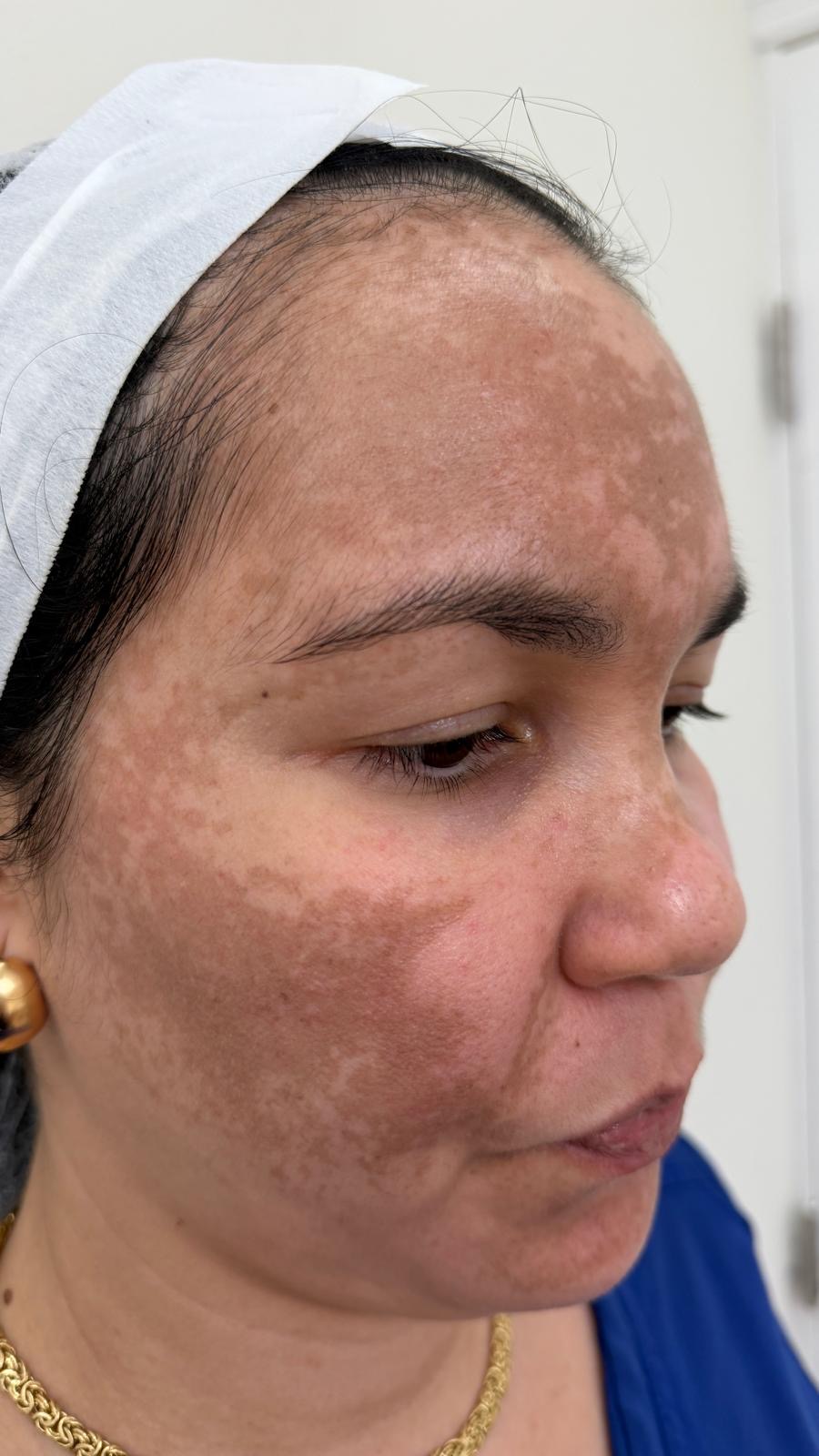 Antes del tratamiento: melasma severo en mejilla y frente