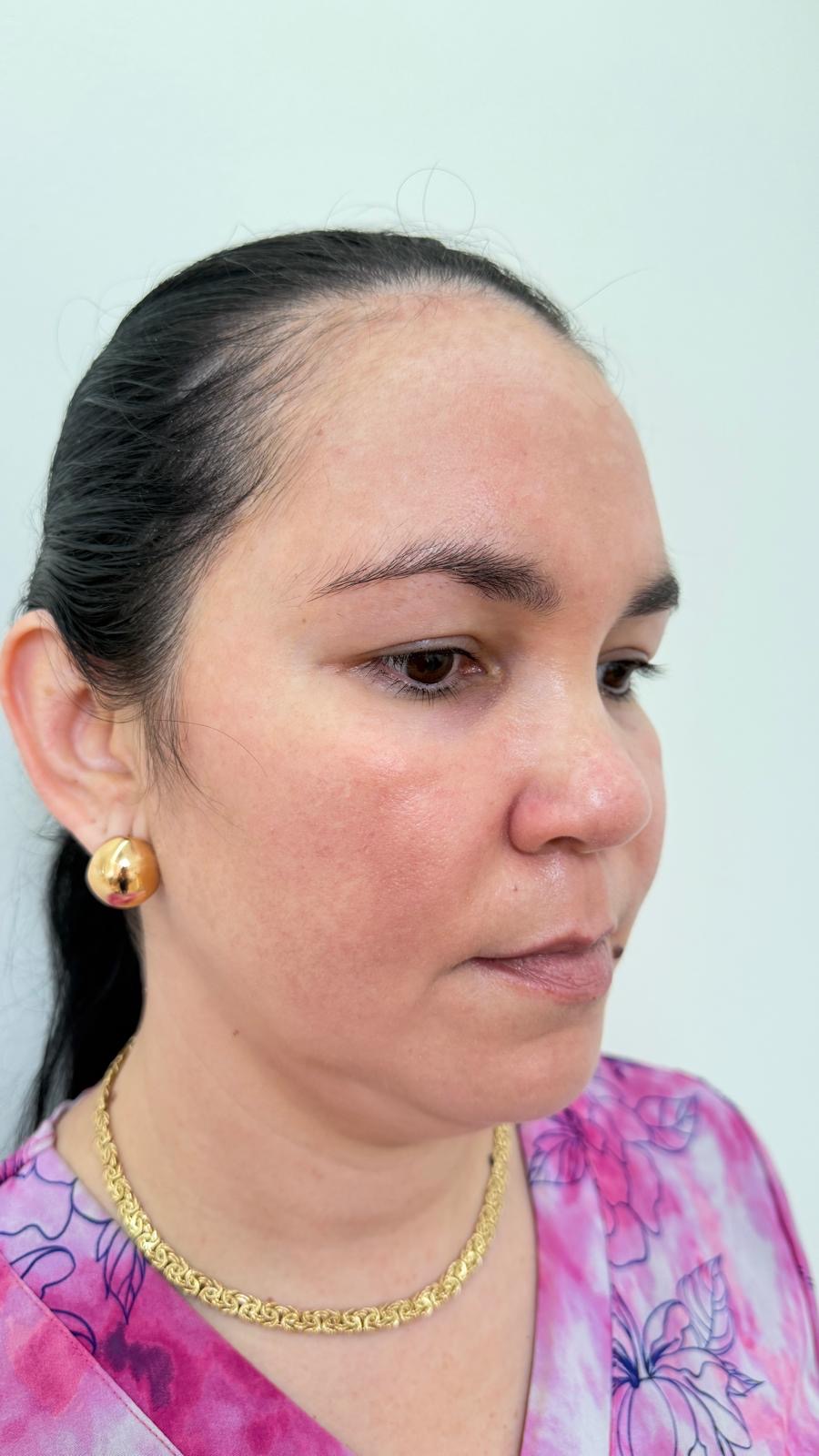 Después del tratamiento de melasma: piel uniforme y luminosa