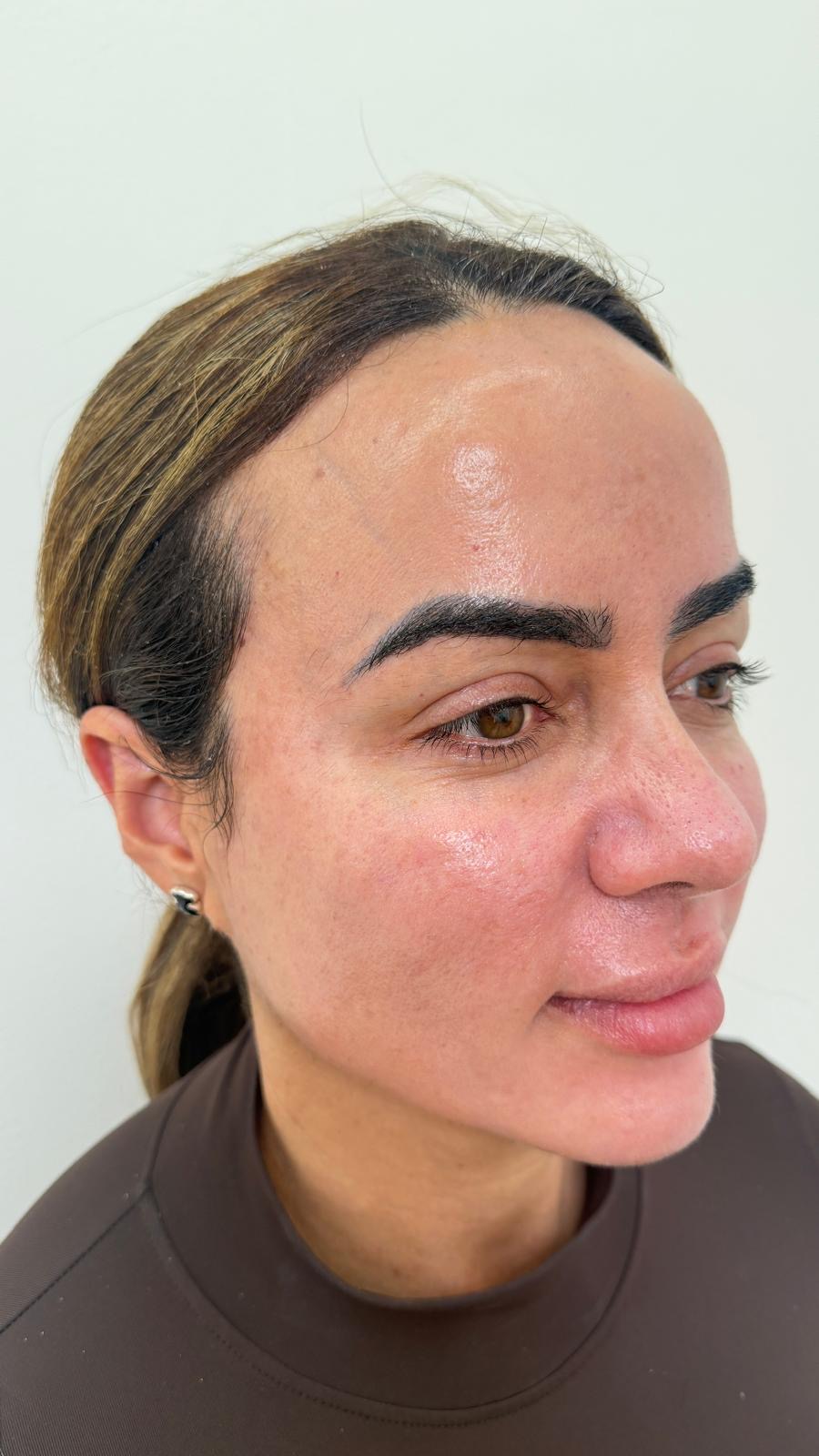 Antes del tratamiento facial: textura y poros visibles