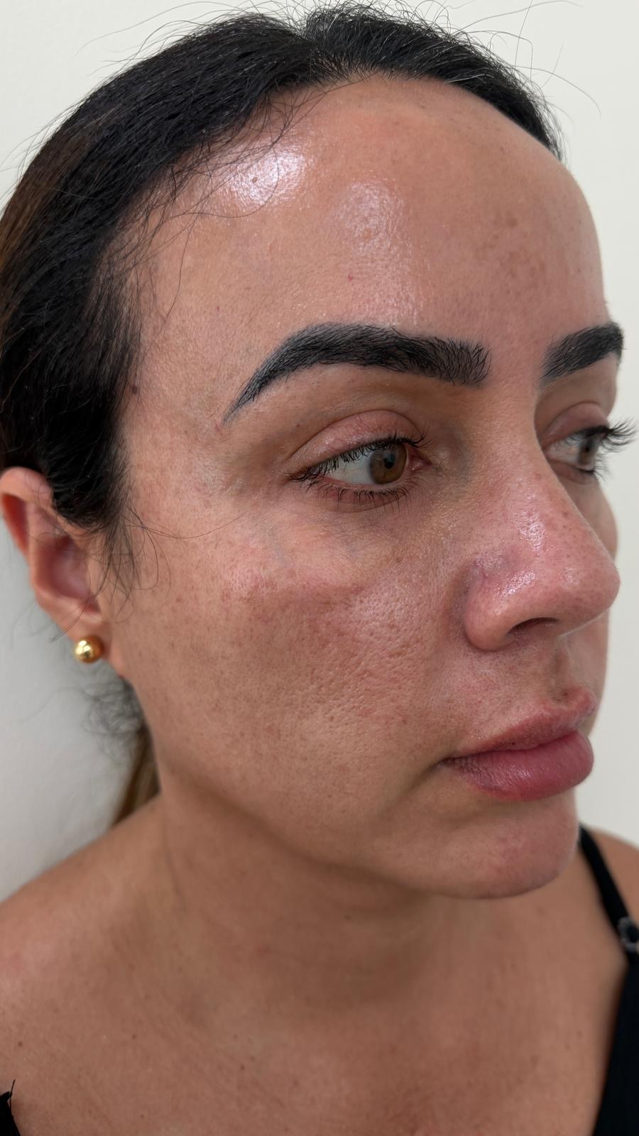 Después del tratamiento facial: piel suave y revitalizada