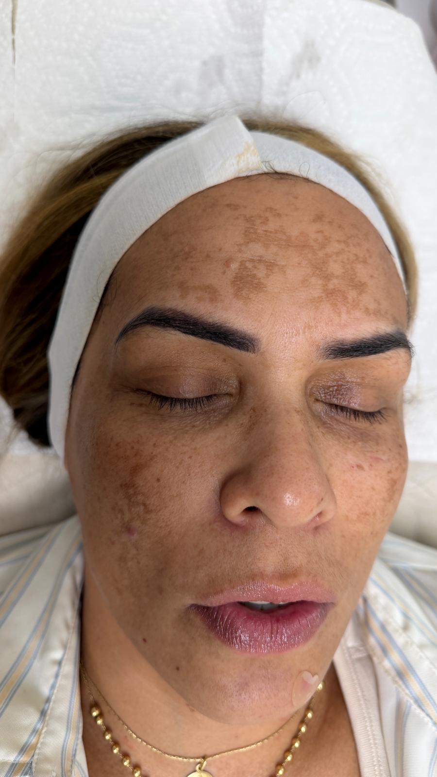 Antes del tratamiento: melasma e hiperpigmentación